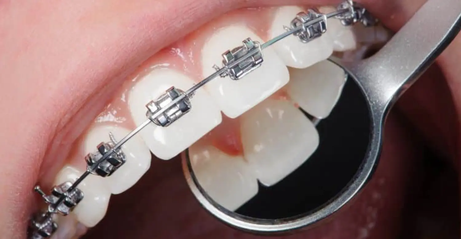 how long does orthodontic treatment take 2